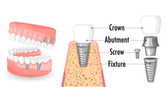 Structure of Dental Implants in Virginia